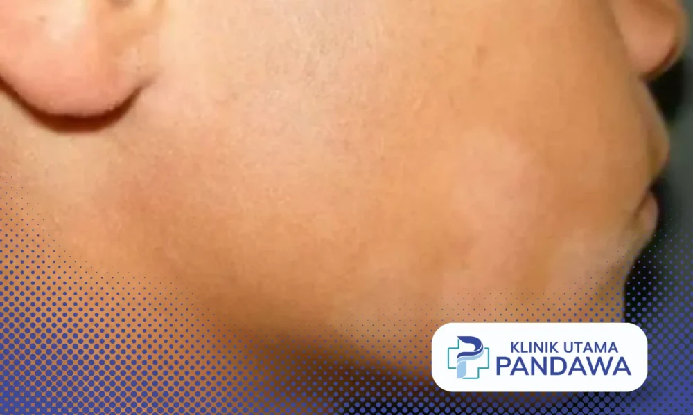 Pityriasis Alba