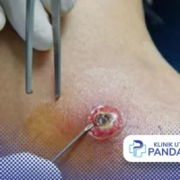 Prosedur Medis Bisul