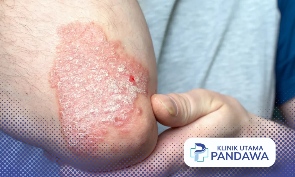 Psoriasis