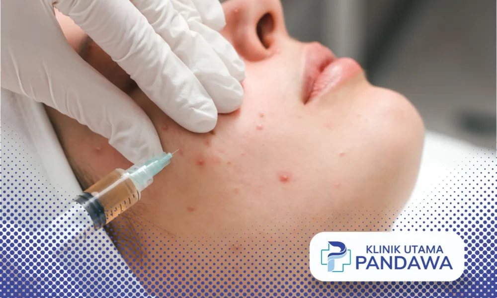 acne treatment adalah
