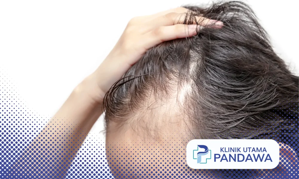 alopecia androgenik
