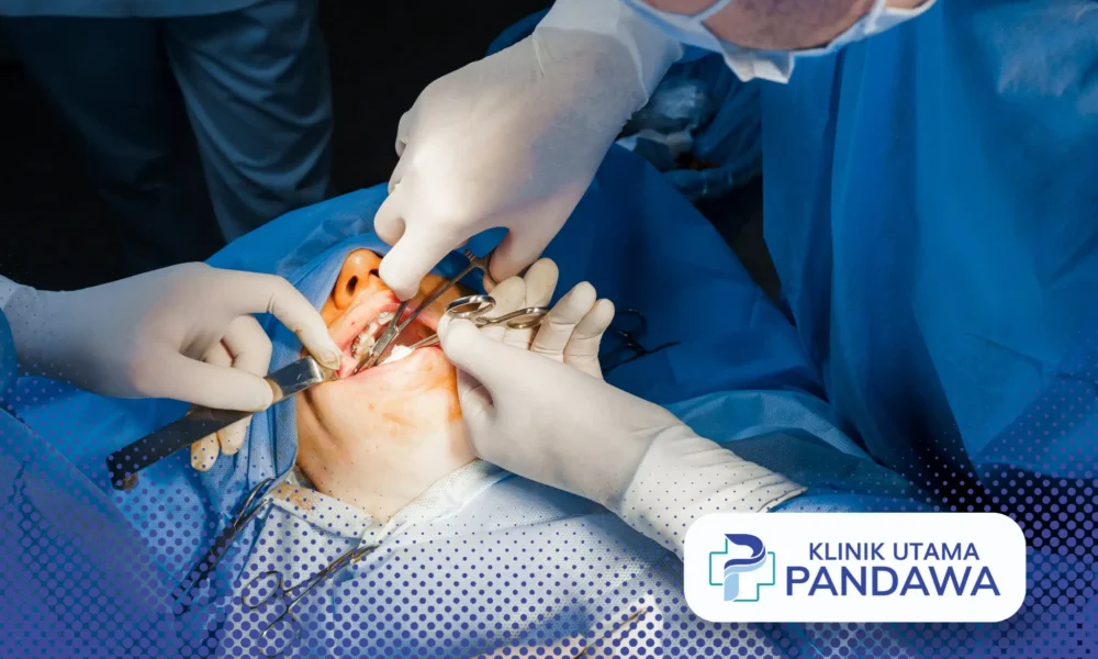 buccal fat removal