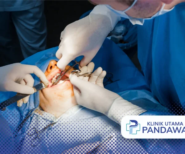 buccal fat removal
