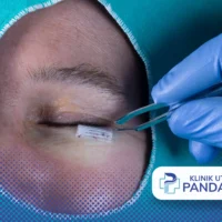 eyelid surgery