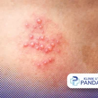 herpes genital wanita