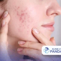 jerawat klasik