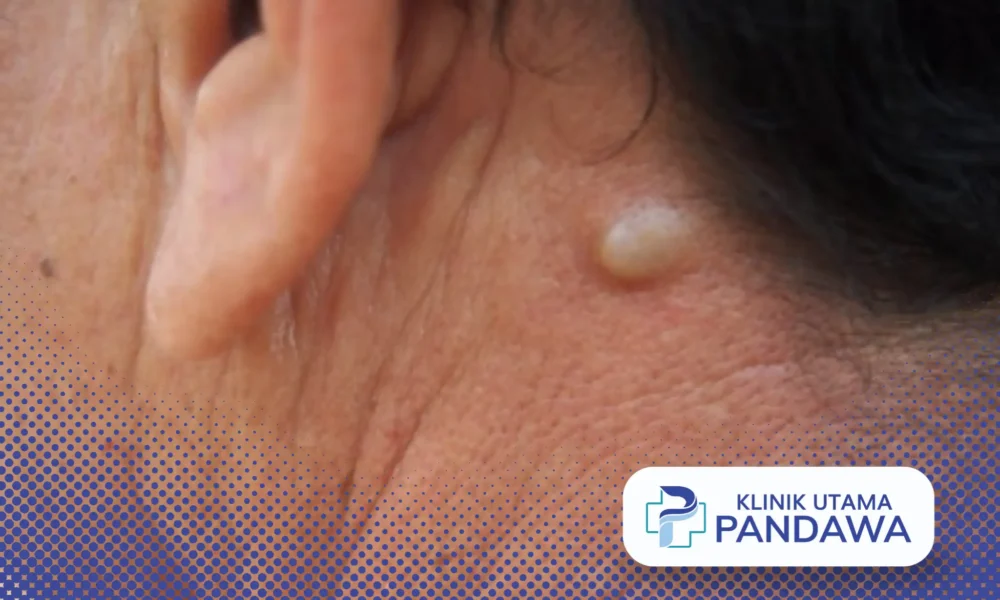 kista epidermoid