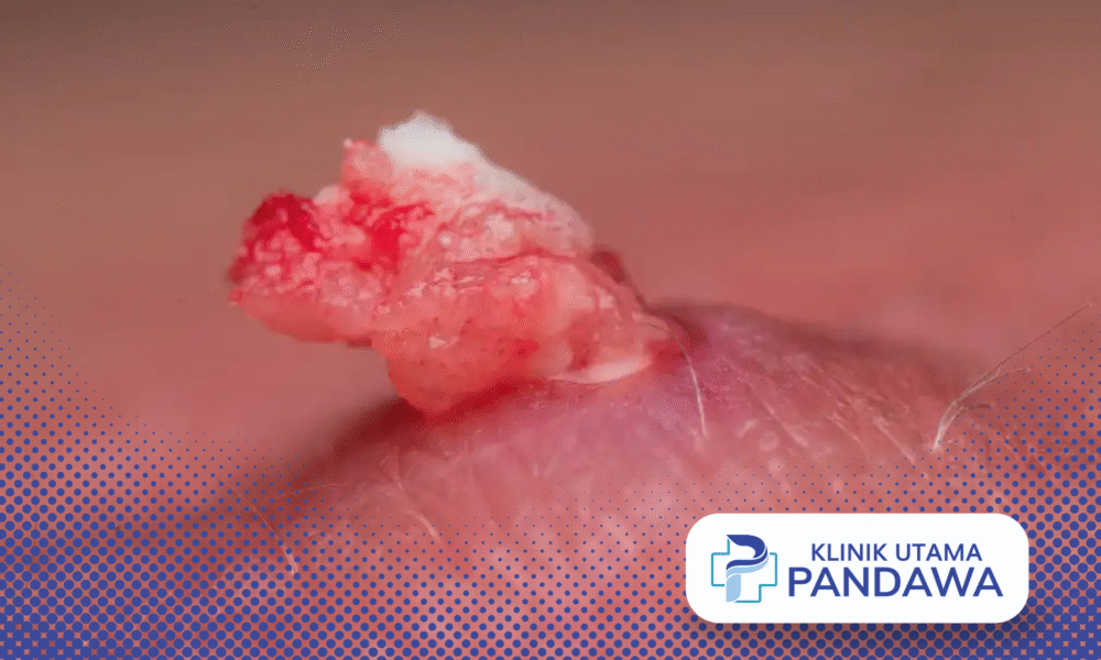 kista epidermoid