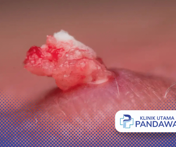 kista epidermoid