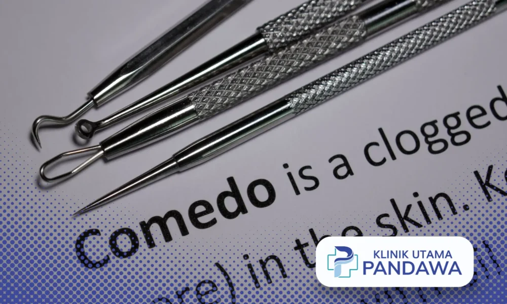 komedo