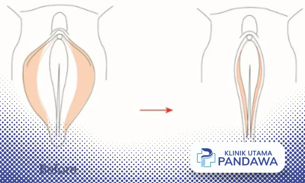 labiaplasty