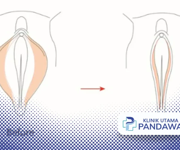 labiaplasty