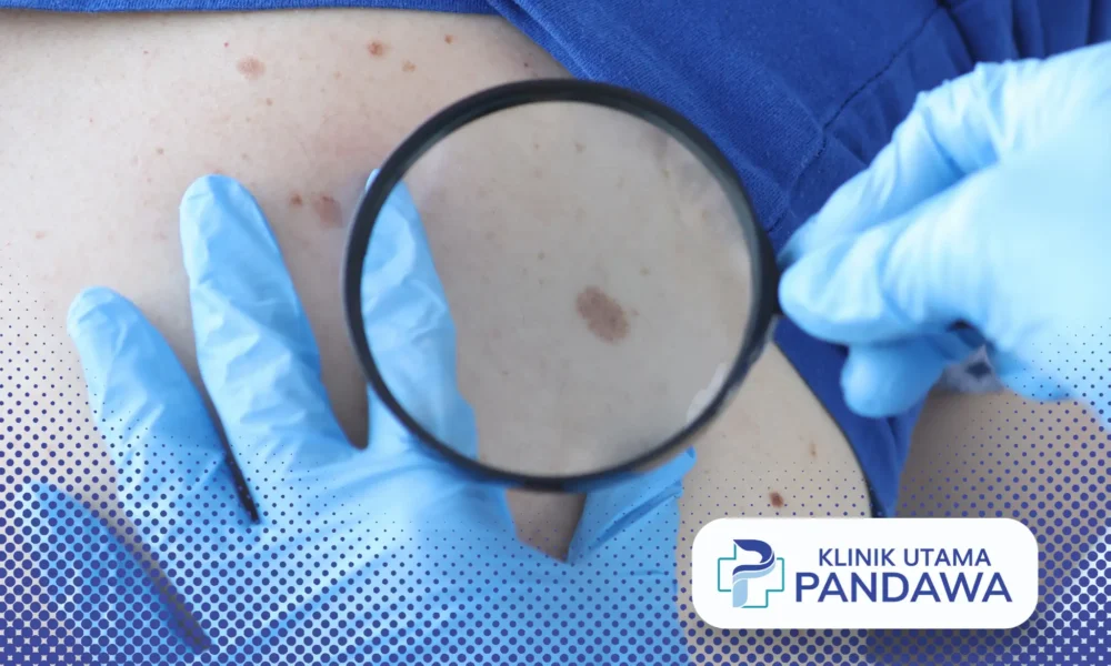 nevus pigmentosus