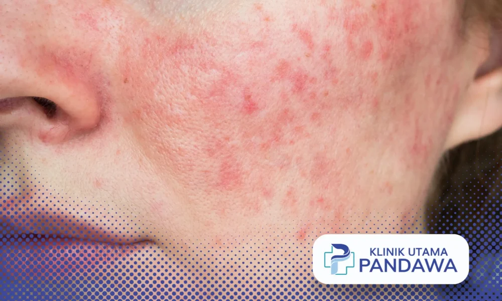 rosacea