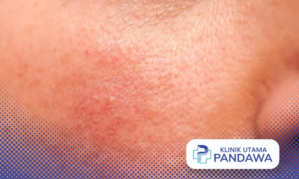 skin barrier