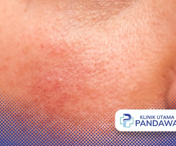 skin barrier