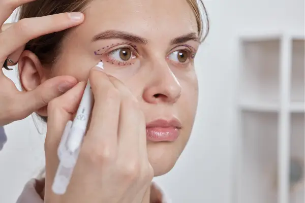 Blepharoplasty upper