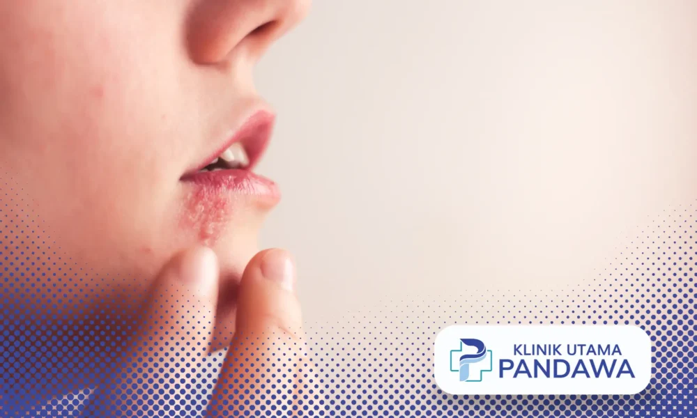 Cara Mengobati Herpes Pada Anak