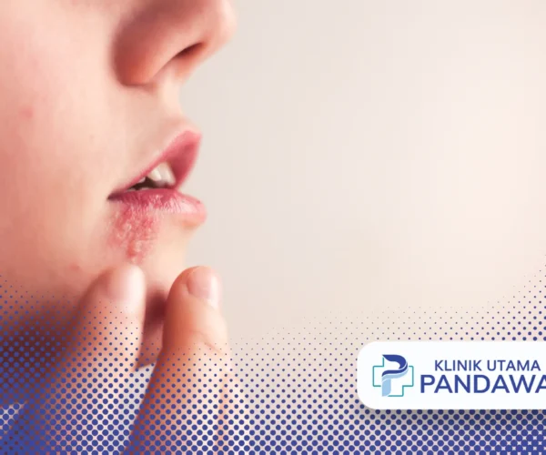 Cara Mengobati Herpes Pada Anak