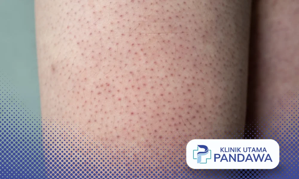 Keratosis pilaris