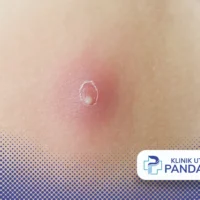 abses kulit