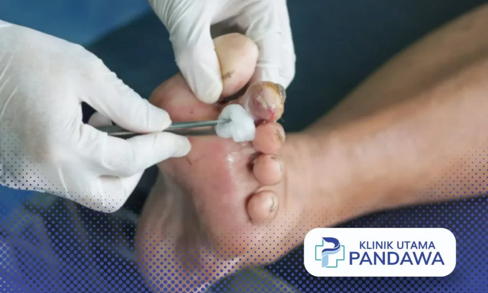 debridement adalah