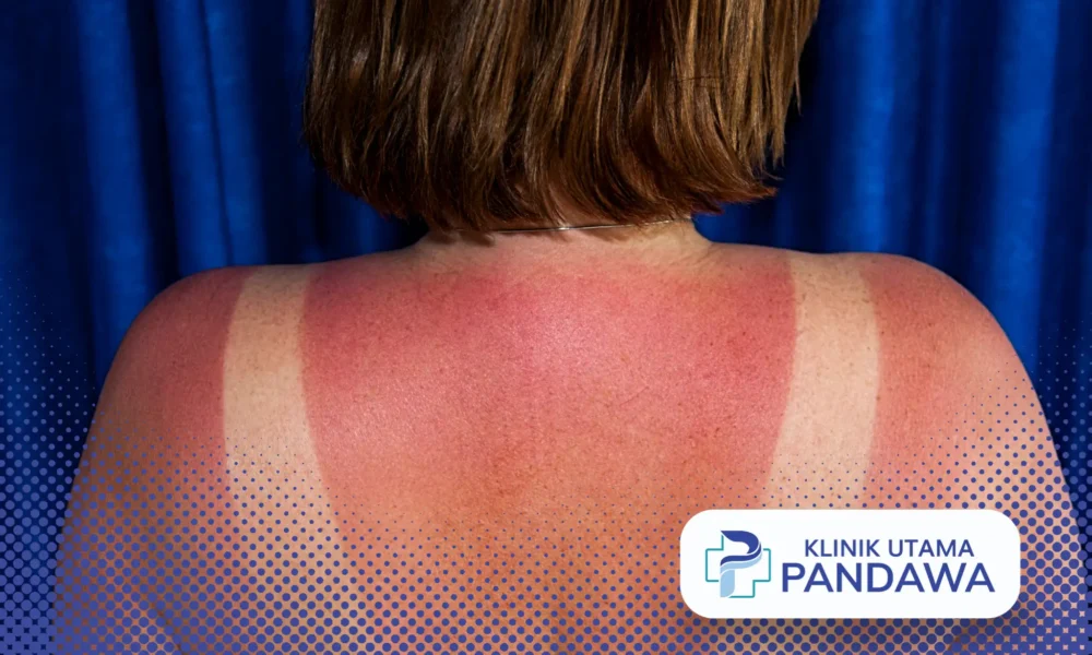obat sunburn