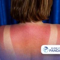 obat sunburn