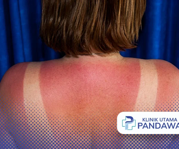 obat sunburn