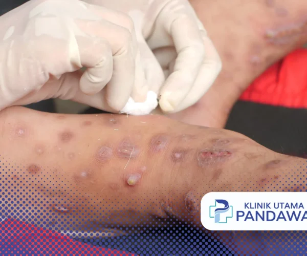 scabies