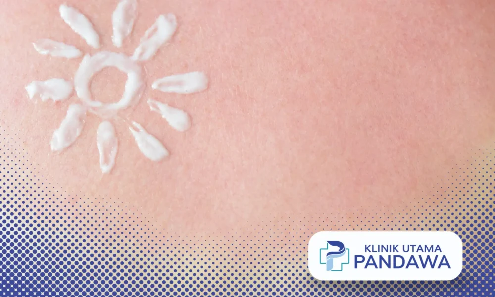 sunburn adalah