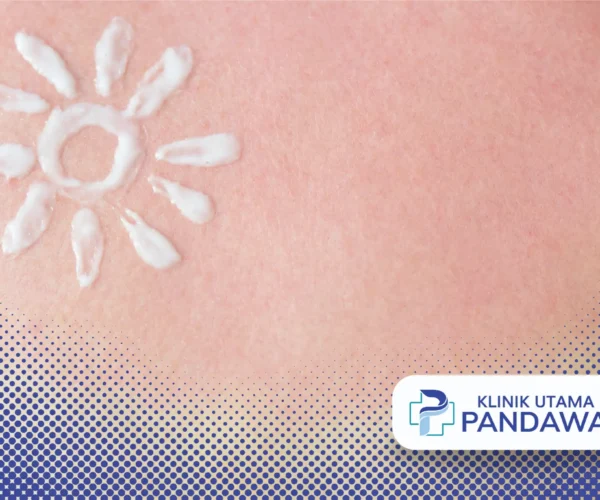 sunburn adalah