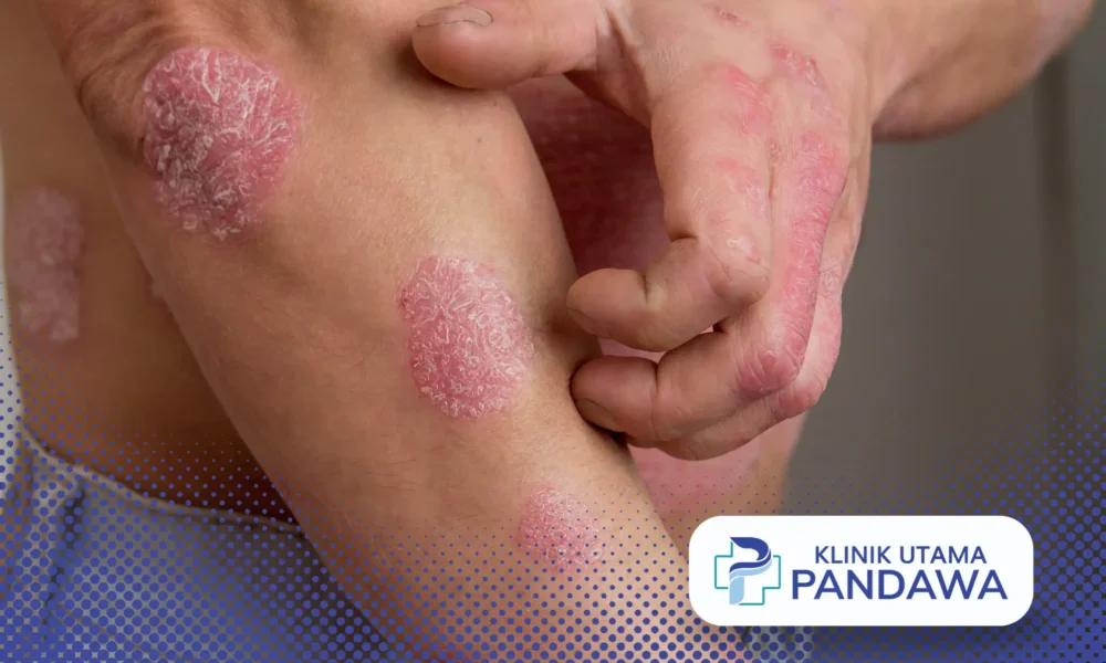 tanda psoriasis sembuh