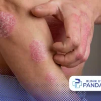 tanda psoriasis sembuh