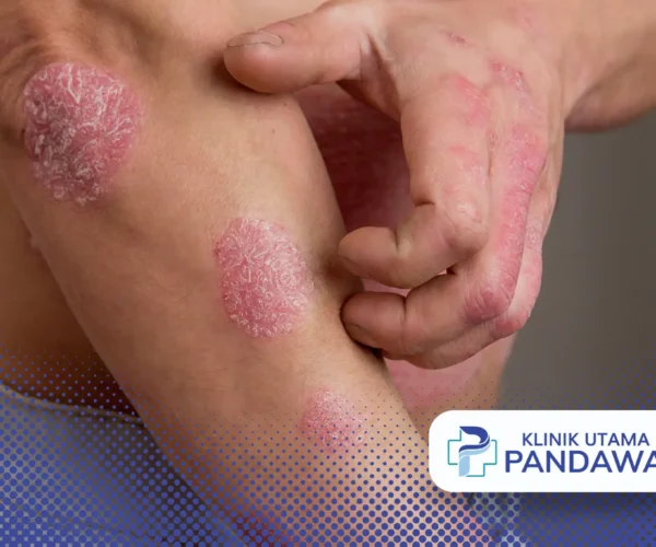 tanda psoriasis sembuh