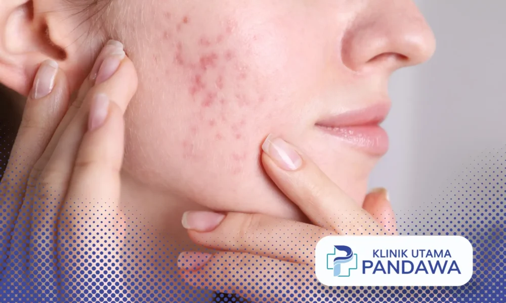 acne prone skin adalah