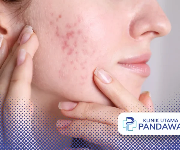acne prone skin adalah