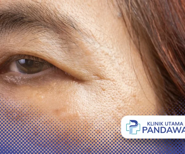 cara menghilangkan mata panda