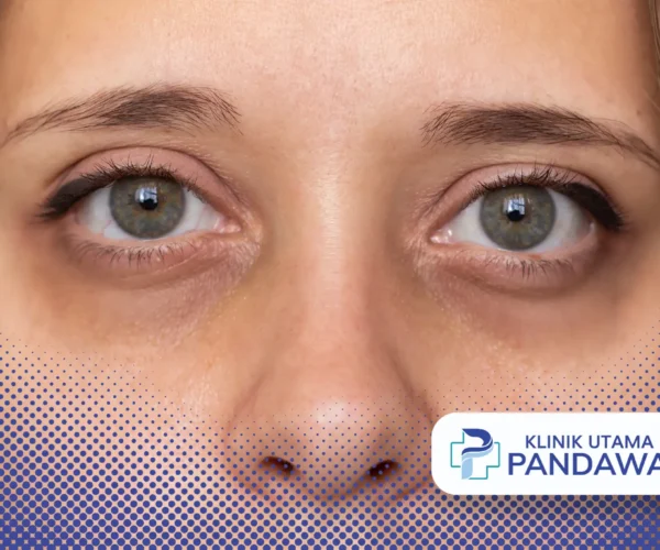 cara menghilangkan mata panda