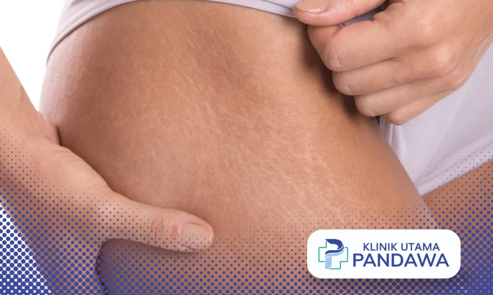 cara menghilangkan stretch mark