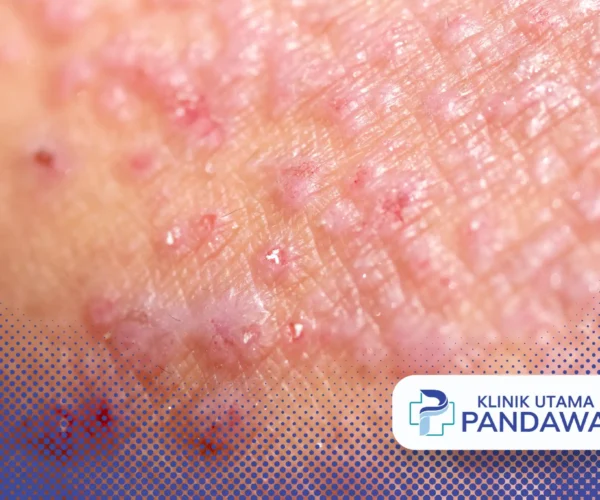 dermatitis kontak