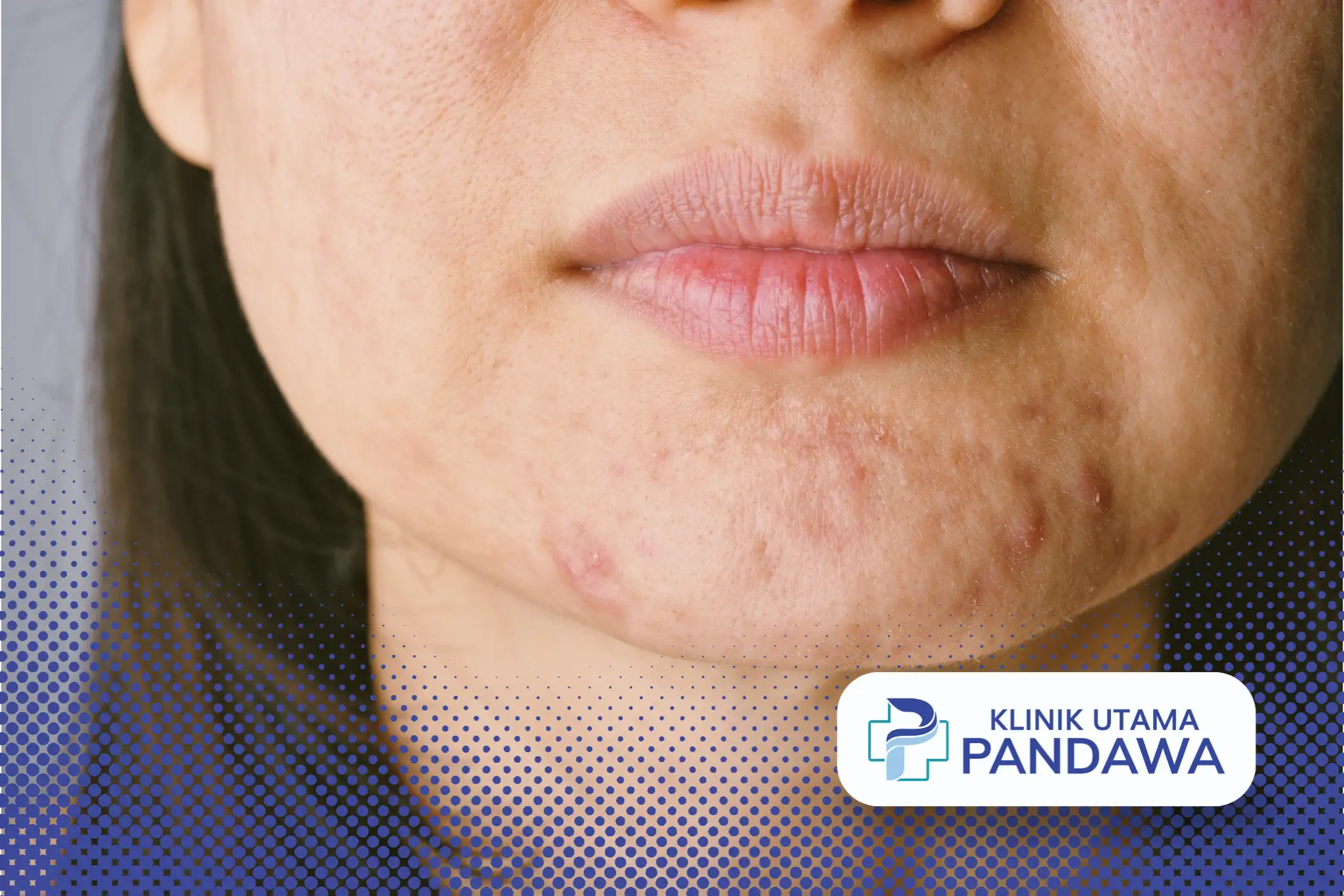 Jerawat di Dagu Tak Kunjung Hilang? Ini Rahasia Mengatasinya - Klinik