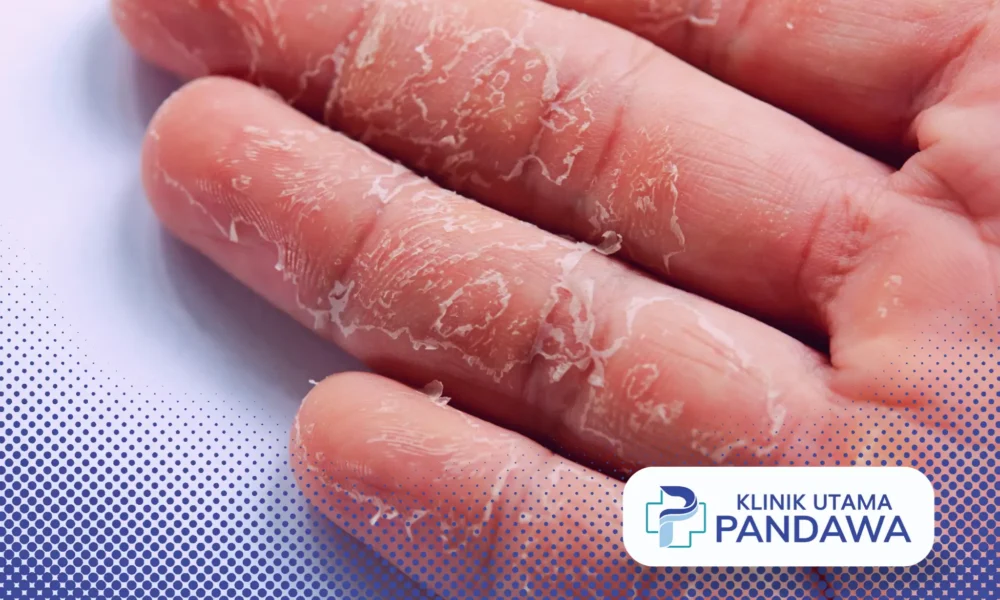 kulit tangan mengelupas