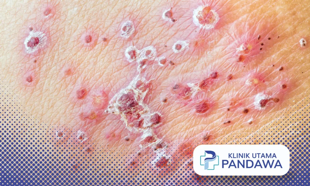 Herpes Neonatal