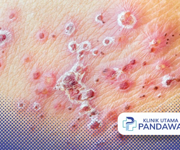 Herpes Neonatal