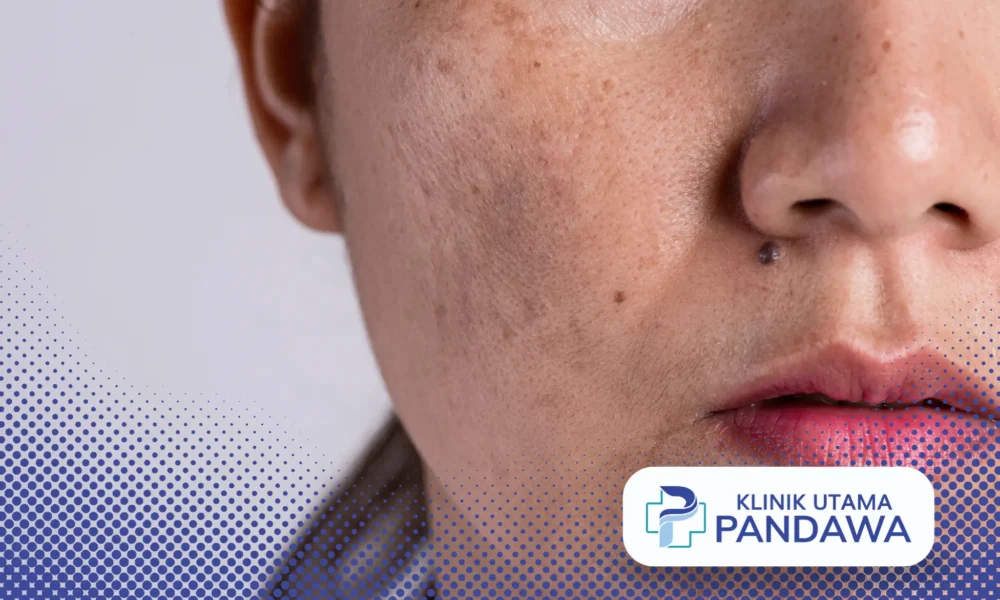 cara menghilangkan melasma