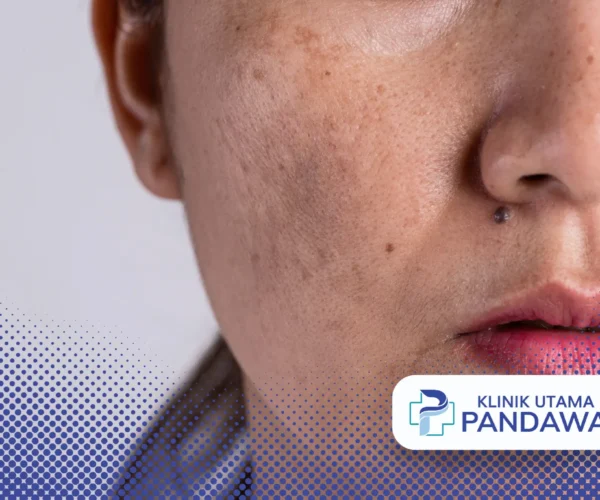 cara menghilangkan melasma