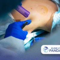 cara menghilangkan tompel