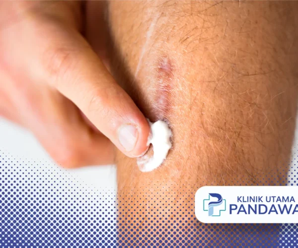 scar removal cream