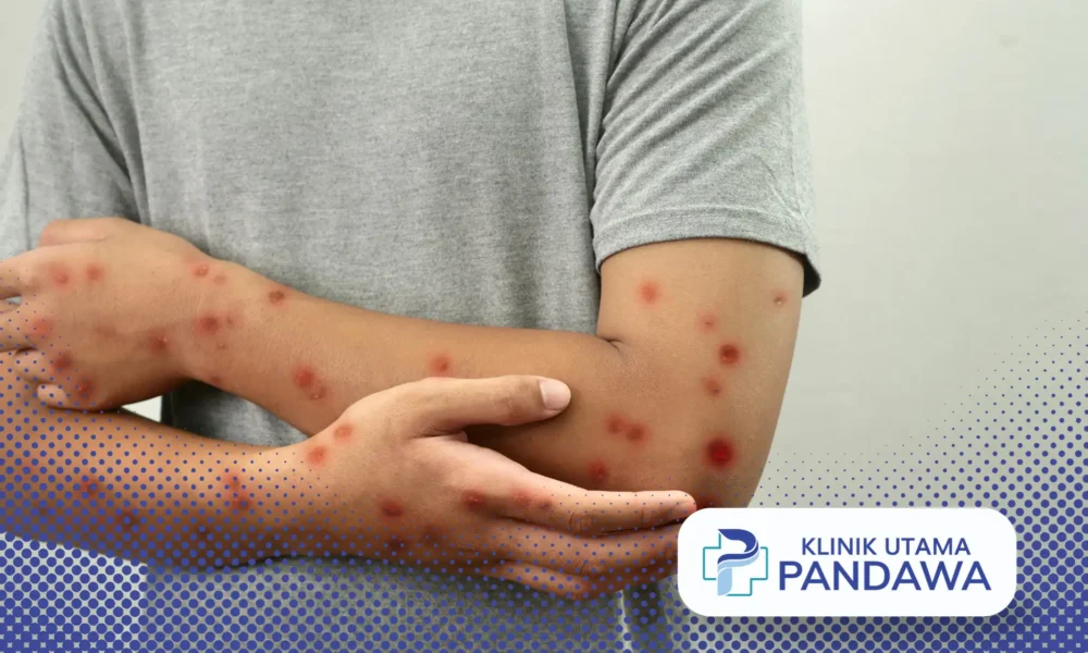 cara mencegah cacar air agar tidak bertambah banyak